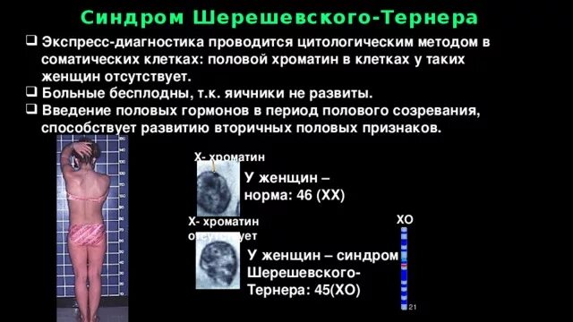 Как выглядят дети шерешевского тернера Презентация к уроку биологии "Дифференциация пола" 10 класс с углубленным изучен