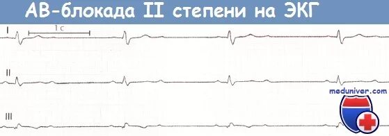 Блокада показания. АВ блокада 2 степени на ЭКГ. АВ блокада 2 степени Мобитц 2 на ЭКГ. АВ блокада 2 степени Мобитц 1 на ЭКГ. Атриовентрикулярная блокада 2 степени на ЭКГ.