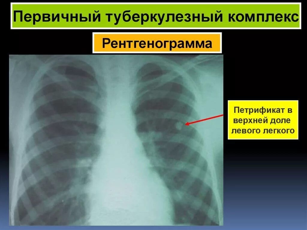 Единичный петрификат. Петрификат туберкулез. Рентген лёгких. Симптом снежной бури на рентгенограмме. Кальцинат на рентгене легких.