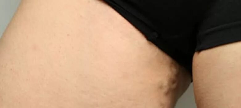 Как выглядит паховый лимфоузел. Пахово бедренные лимфоузлы. Паховый лимфогранулематоз. Лимфатические узлы нижней конечности схема. Как выглядит паховый лимфоузел.