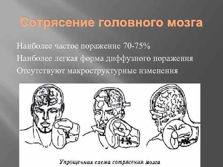 Удар затылком сотрясение. Сотрясение головного мозга. Черепно-мозговая травма сотрясение головного мозга.