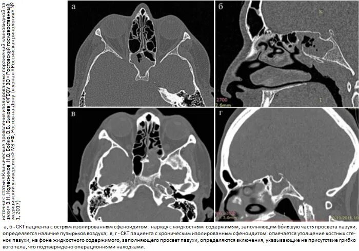 Сфеноидит форум. Сфеноидит воспаление клиновидной пазухи. Хронический сфеноидит на кт. Клиновидная пазуха на кт. Кт пазух носа сфеноидит.