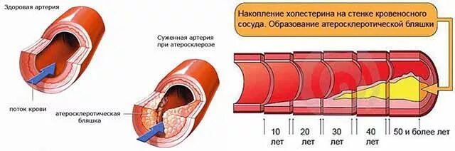 Толстая стенка сосуда. Холестериновые бляшки в сосудах. Накопление холестерина в сосудистой стенке. Атеросклеротические бляшки в сосудах. Холестерин бляшки в сосудах.