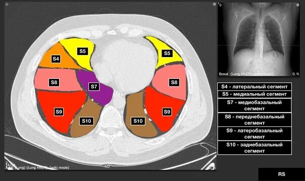 Доли легкого на кт. Сегменты легких кт Radiology 24. Сегменты s1 s2 легких. Кт сегменты легких Сагиттальный срез. S6 сегмент на кт легких.