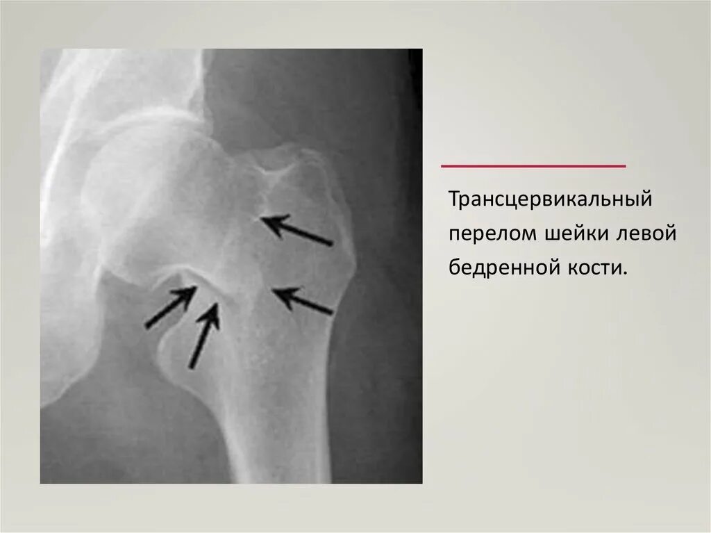 Субкапитальный перелом шейки левой бедренной кости. Субкапитальный вколоченный перелом шейки левой бедренной кости.. Лизис шейки бедренной кости. Субкапитальный перелом шейки правой бедренной кости. Шейки левого бедра