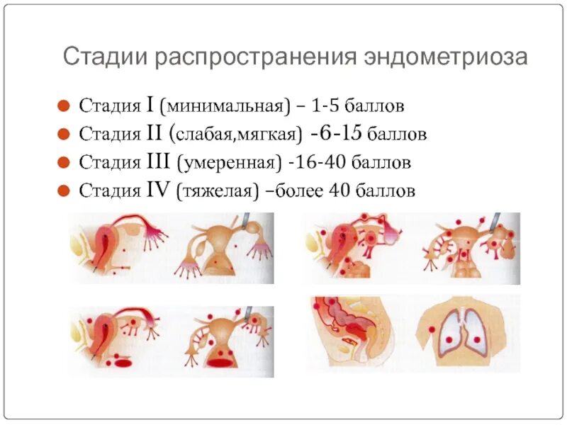 Наружный генитальный эндометриоз. Классификация. Этиопатогенез. Диагностика