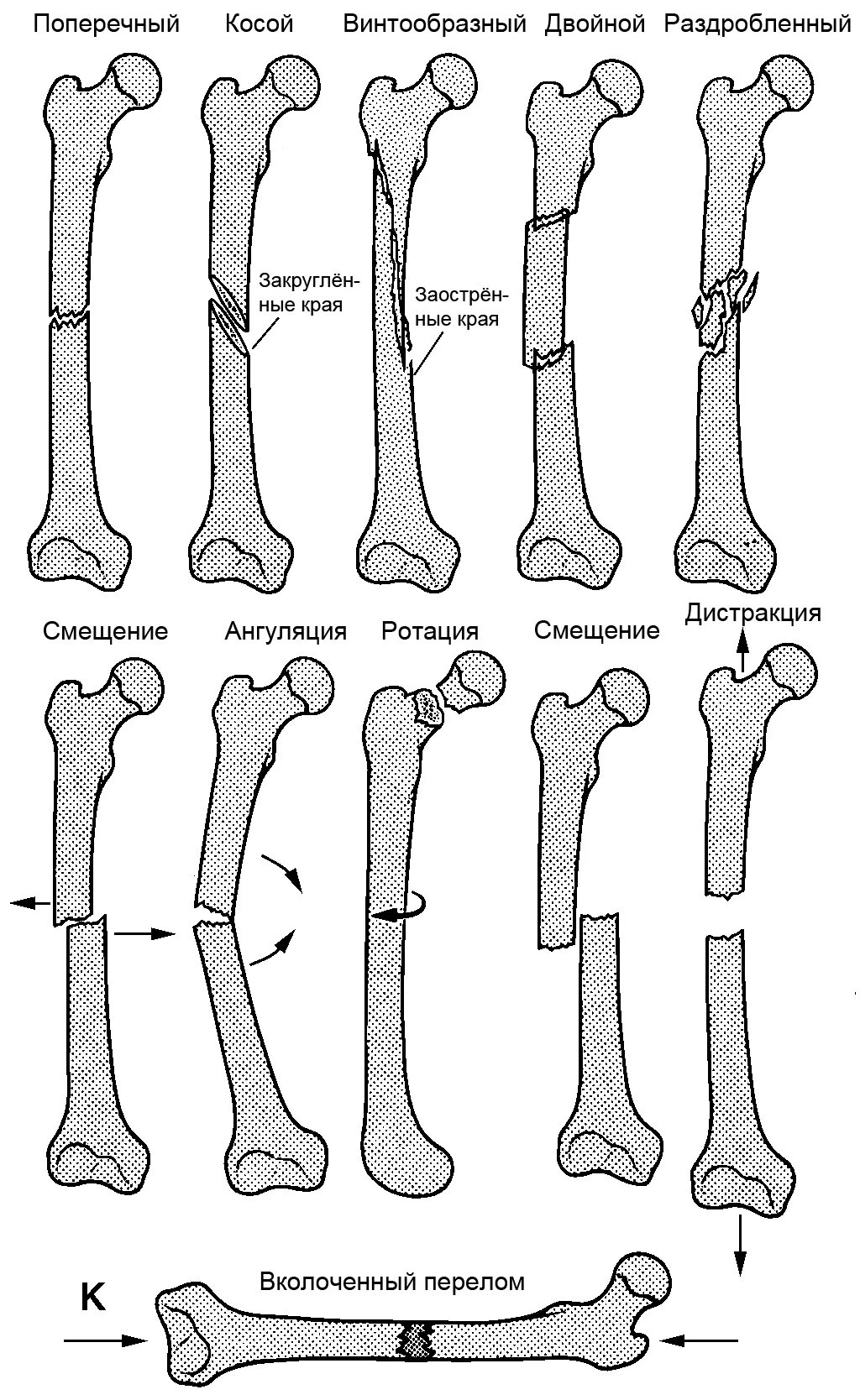 Классификация переломов диафизарной части плечевой кости. Винтообразный оскольчатый перелом бедра. Смещение отломков при переломе бедренной кости. Классификация диафизарных переломов бедренной кости.