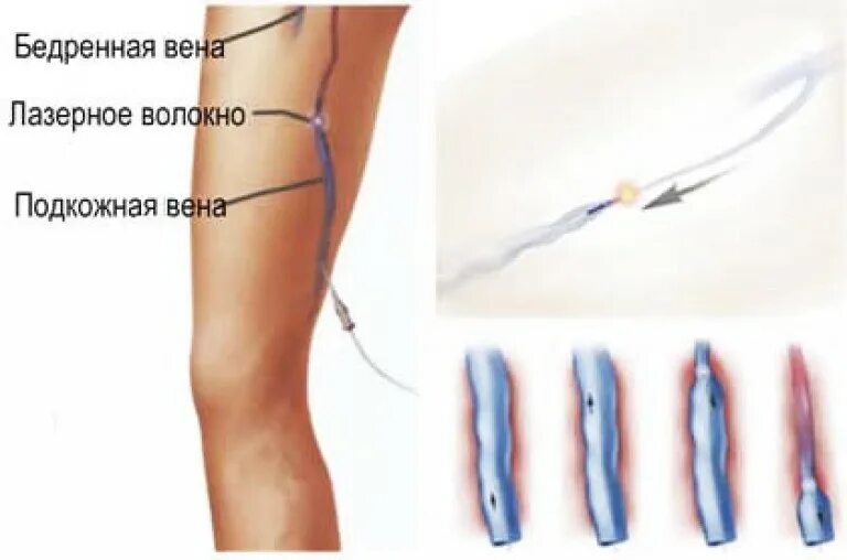 Варикозное расширение вен склеротерапия. Эндовазальная коагуляция вен нижних. Склеротерапия варикозной болезни. Эндовазальная лазерная коагуляция вен. Удаление тромба цена