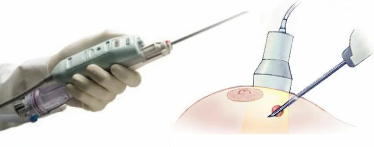 Трепанобиопсия молочной железы что это. Тонкоигольная аспирационная биопсия. Тонкоигольная аспирационная биопсия молочной железы. Тонкоигольная аспирационная биопсия щитовидной железы. Игла для трепан биопсии молочной железы.