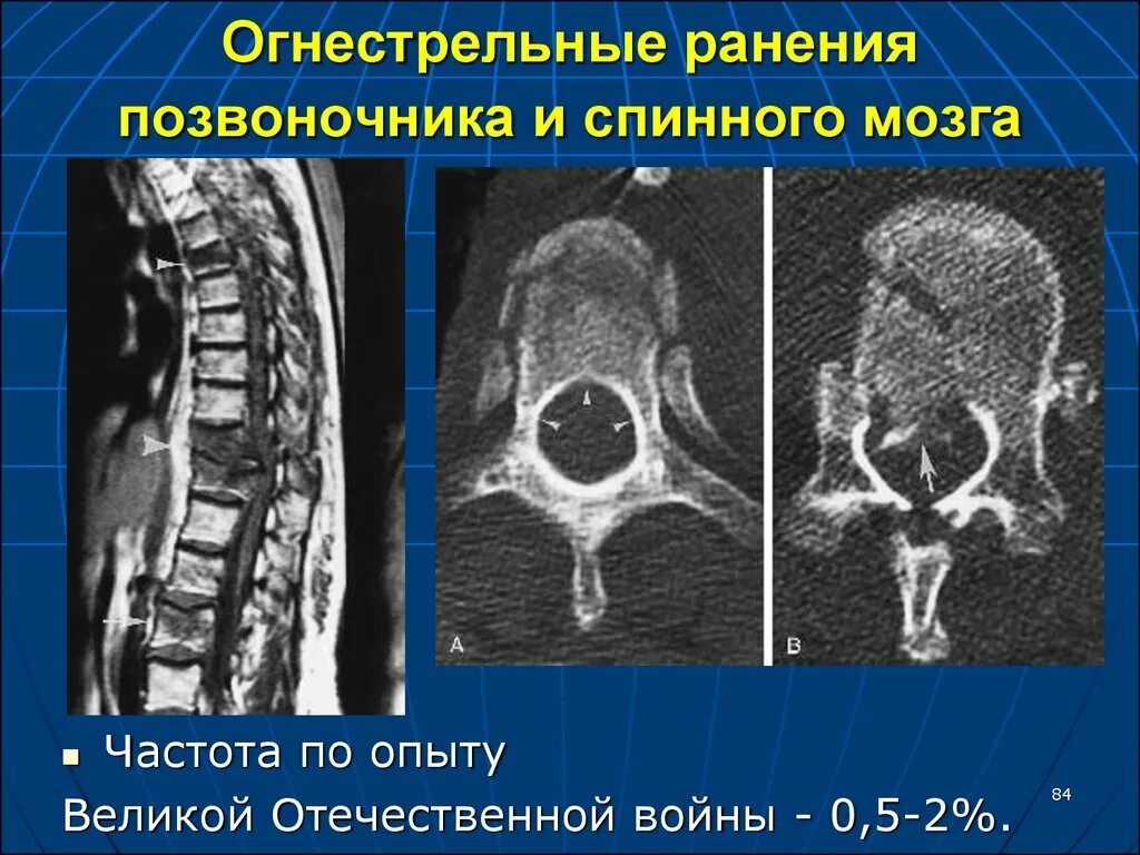 Сотрясение позвоночника. Огнестрельные ранения позвоночника и спинного мозга. Огнестрельное ранение позвоночника. Осколочное огнестрельное ранение. Огнестрельные повреждения позвоночника.