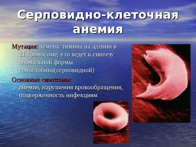 Серповидноклеточная анемия формы. Серповидная клеточная анемия симптомы. Серповидноклеточная анемия мутация. Серповидно-клеточная анемия (s-гемоглобинопатия). Серповидноклеточная анемия основные симптомы.