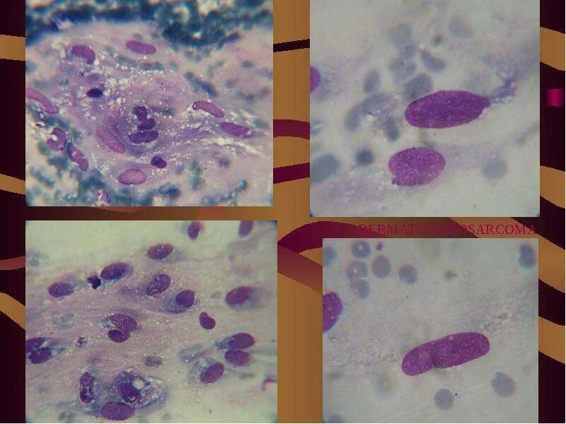 Опухоли кожи цитология. Цитология карциномы кожи.