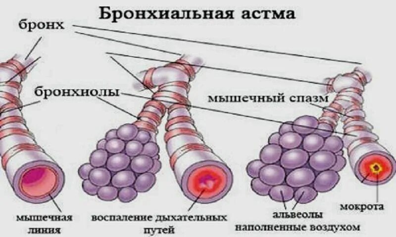 Передается ли астма по наследству. Передается ли астма по наследству. Генетическая предрасположенность к бронхиальной астме. Астма передается по наследству или нет. Астма передается по наследству или нет.