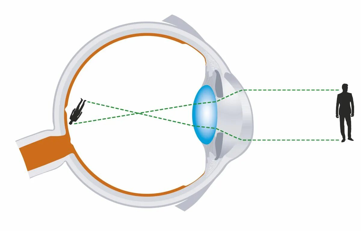 Фокусировка лучей света на внутренней. Миопия дальнозоркость астигматизм. Миопия гиперметропия астигматизм пресбиопия. Близорукий глаз. Рефракция миопия.