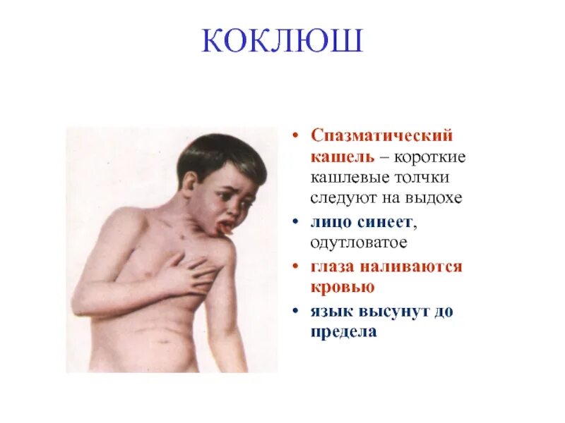 Пропадает ли голос при коклюше