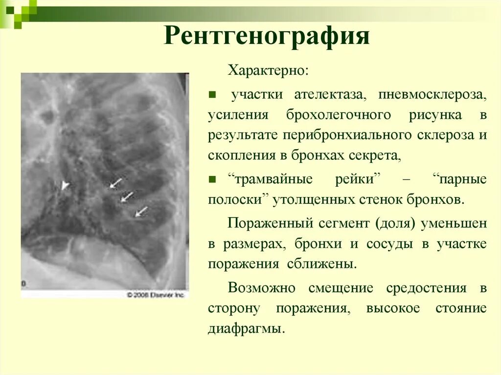 Фиброзно склеротические изменения