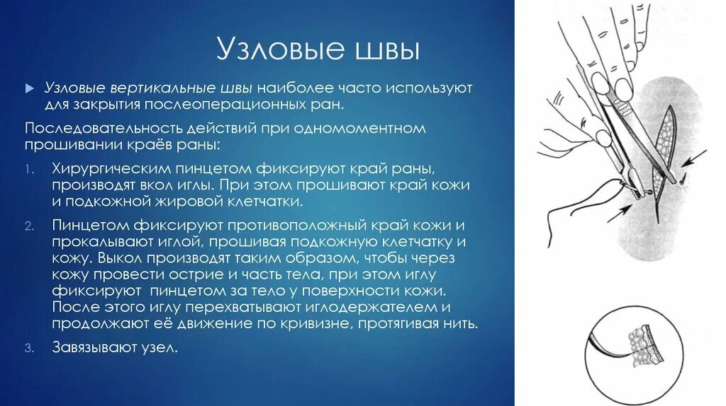 Прост в использовании без. Снятие хирургических швов. Узловатый хирургический шов. Снятие узловых кожных швов.. Этапы наложения кожных швов.