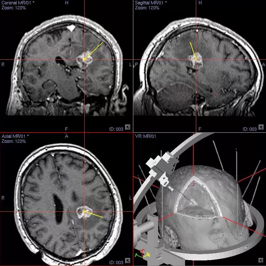 Объемное образование головного мозга код. Стереотаксическая биопсия опухоли. Стереотаксическая биопсия головного мозга. Стереотаксические операции на головном мозге. Стереотаксическая система для нейрохирургии.