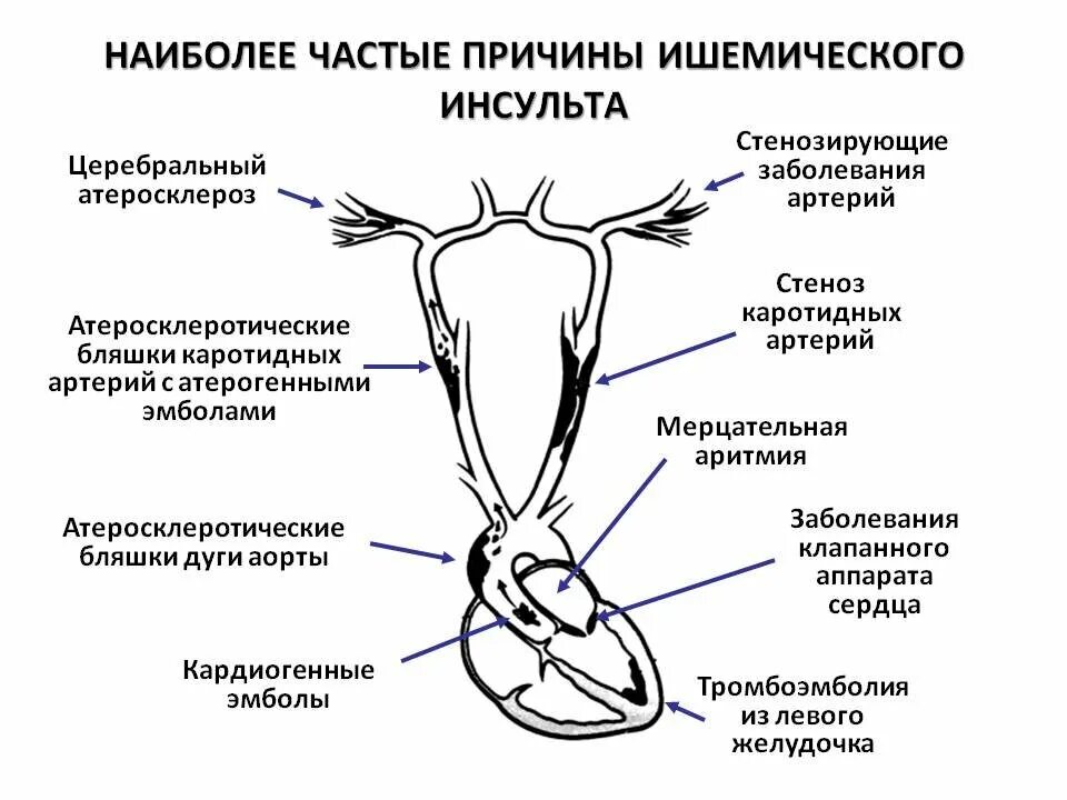 Причины ишемического инсульта. Предпосылки ишемического инсульта. Ишемический инсульт причины возникновения. Наиболее частая причина ишемического инсульта. При каком давлении случается инсульт