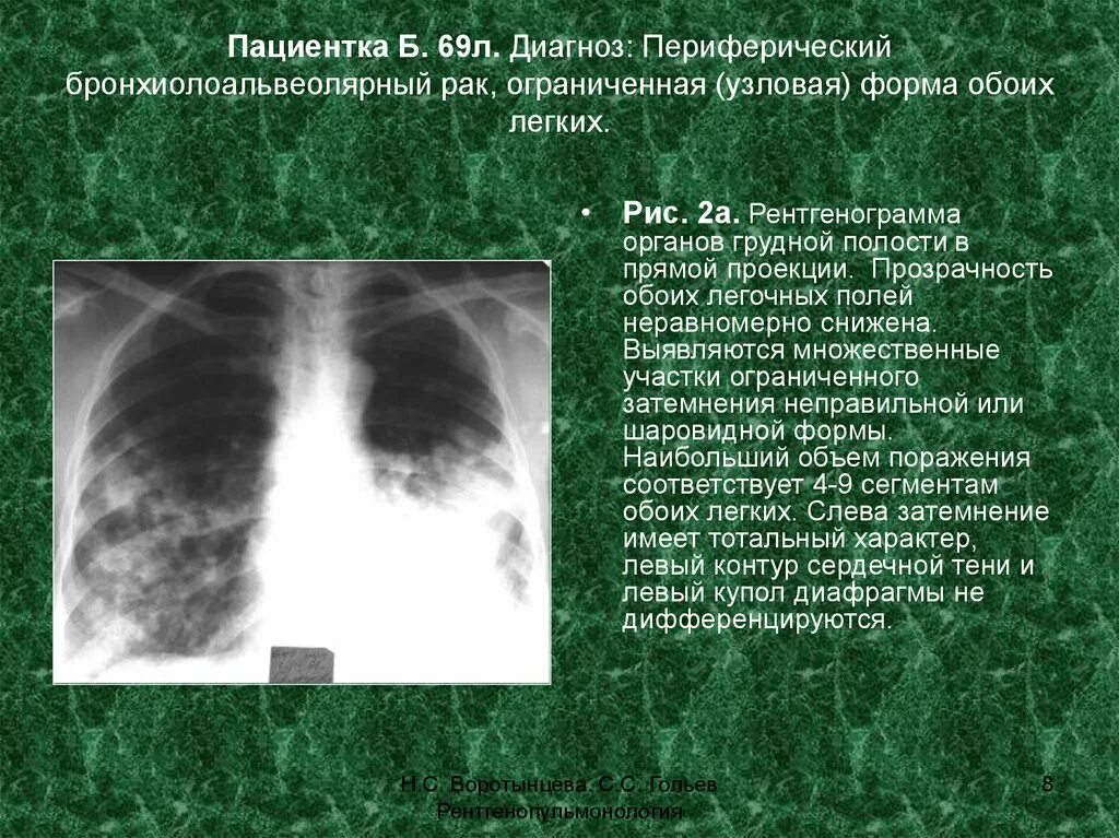 Признаки периферического легкого. Узловая форма карциномы легкого. Периферическое образование легкого. Снижение прозрачности легочных полей. • Пневмониеподобная форма периферического.