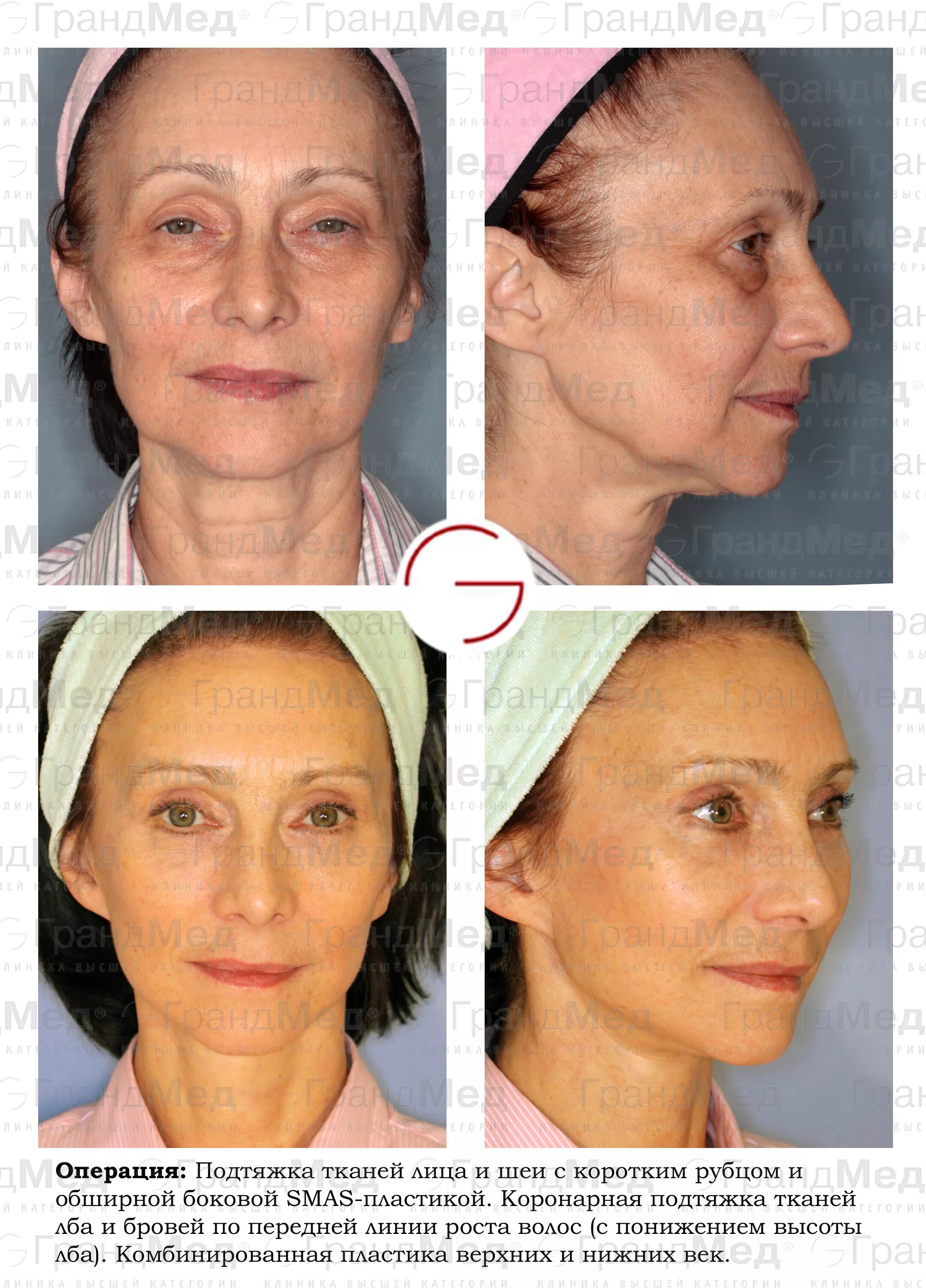 Круговая поддяжкалица. Круговая пластика лица. Круговая поддяжкалица. Сделать круговую подтяжку лица. Лифтинг лица.