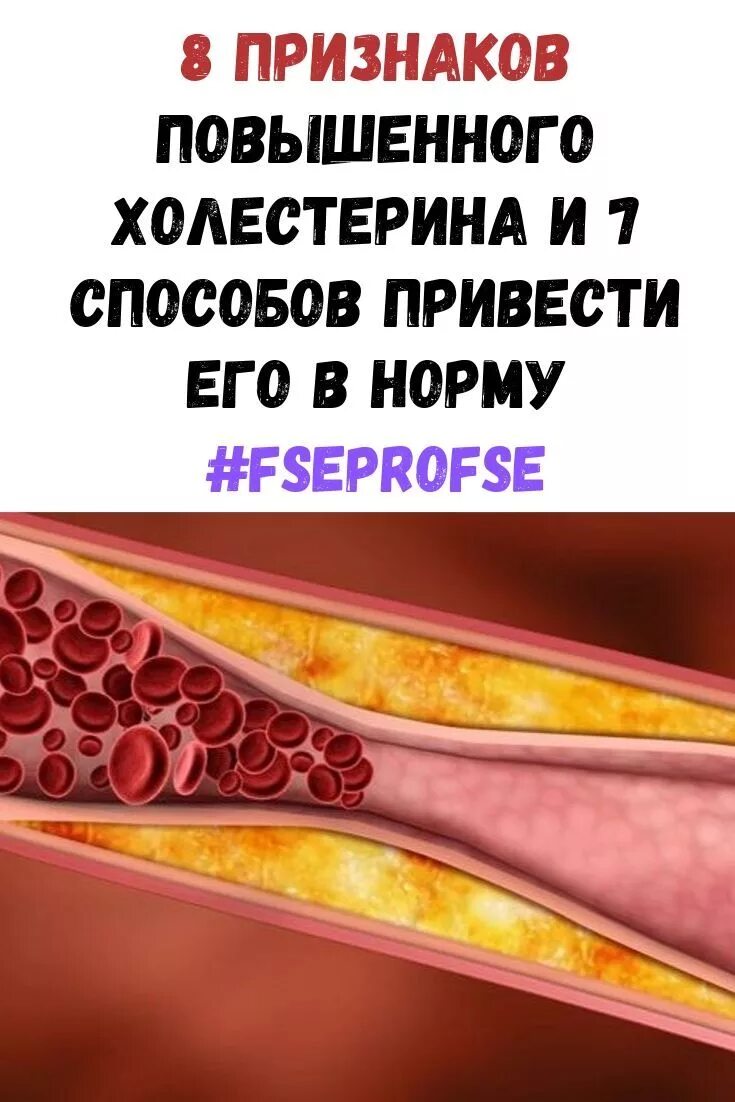 Сильно повышенный холестерин. Холестерин. Симптомы повышенного холестерина. Признаки повышения холестерина. Признаки высокого холестерина у женщин.