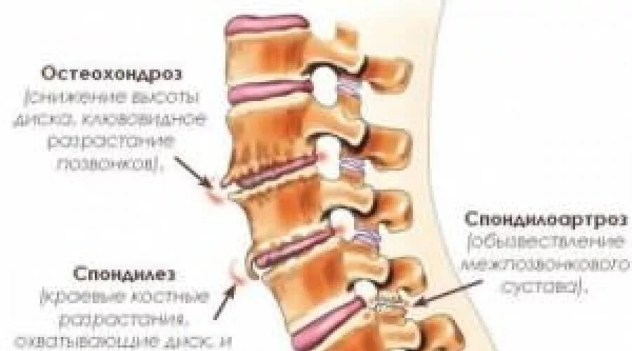 Остеофиты что это такое и как лечить. Спондилоартроз пояснично-крестцового отдела позвоночника. Спондилез и спондилоартроз. Дегенеративно-дистрофические изменения позвоночника что это. Остеохондроз спондилоартроз.