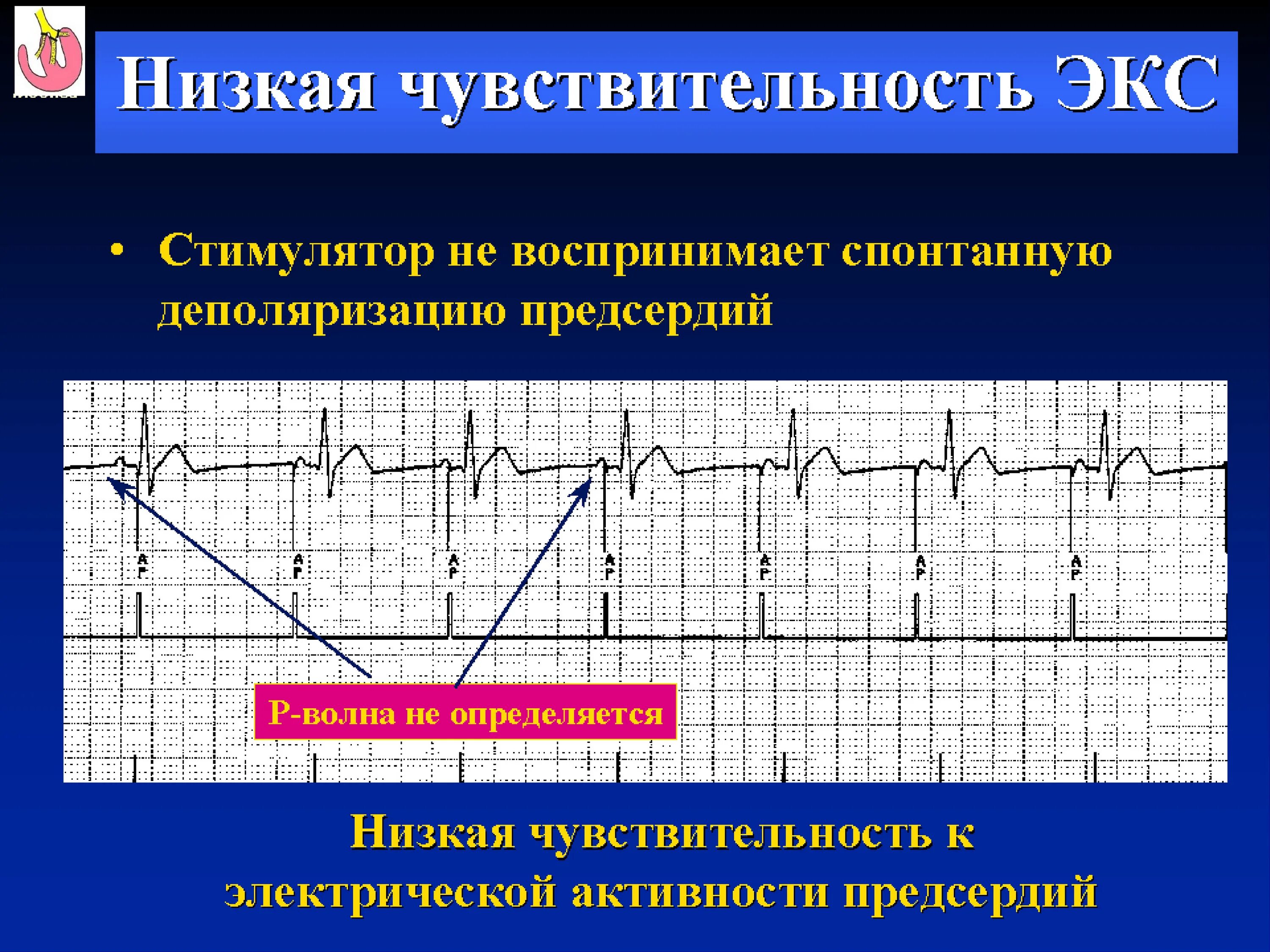Что означает экс. Экс стимуляция предсердий. нарушение чувствительности экс. гипосенсинг по желудочковому каналу. нарушение функции стимуляции экс.