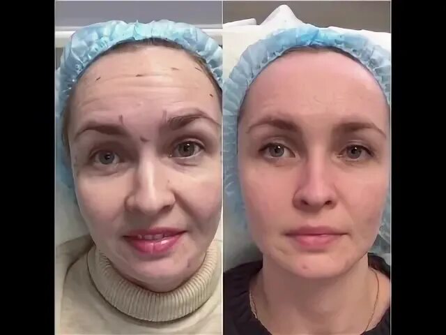 Ботулинотерапия результаты. До и после ботулинотерапии. ботулинотерапия до и после фото. ботулинотерапия рекомендации до и после процедуры. ботулинотерапия глаз до и после.