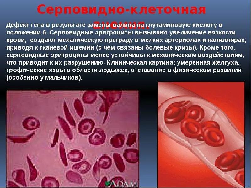 Серповидноклеточная анемия генная. Серповидноклеточная анемия показатели крови. Серповидноклеточная анемия эритроциты. Серповидноклеточная анемия Валин. Дефектный ген что это такое