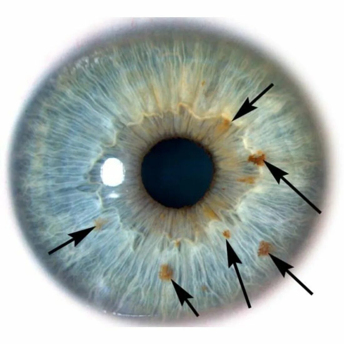 Желтые пятна на радужке глаза. Иридодиагностика глаза. Иридодиагностика по радужной оболочке глаза. Меланома конъюнктивы офтальмология. Мезодермальная дистрофия Радужки.