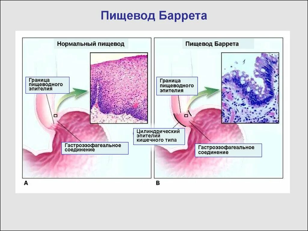 Рефлюкс эзофагит классификация. Пищевод Барретта метаплазия эпителия. Пищевод Барретта клинические рекомендации. Пищевод Барретта патогенез. Эпителий при пищеводе Барретта.