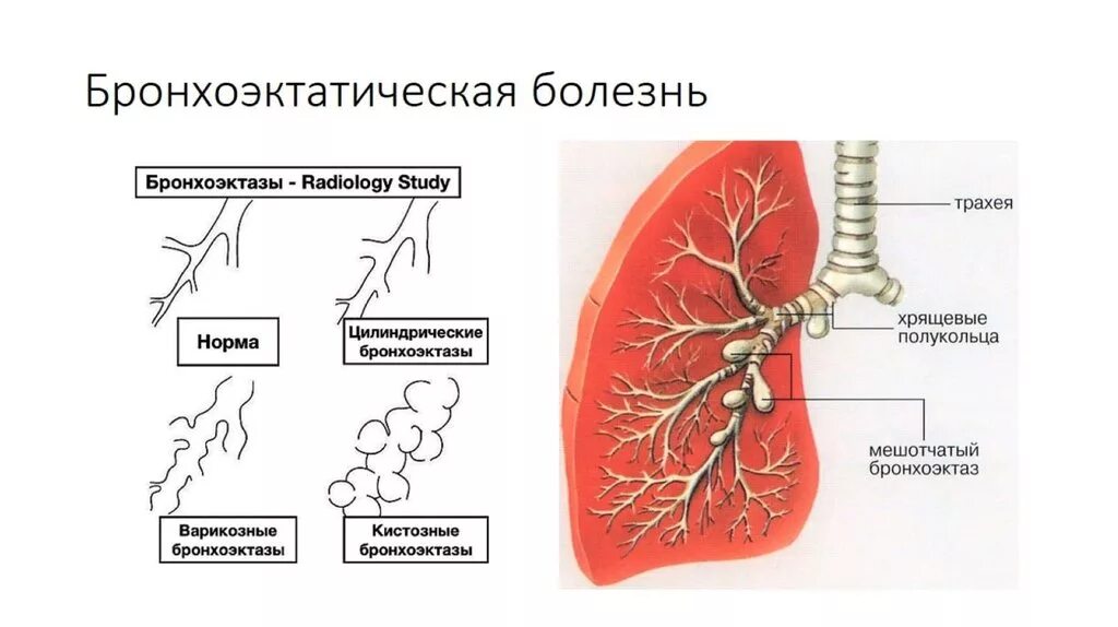 Бронхит латынь. Бронхография бронхоэктазы. Бронхоэктатической расширение бронхов. Бронхоэктазия классификация. Цилиндрические бронхоэктазы схема.