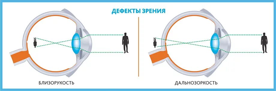 Дефекты зрения близорукость и дальнозоркость. Исправление дефектов зрения близорукость. Глаз. Дефект зрения.. Физика глаз дефекты зрения. Как видят дальнозоркие люди