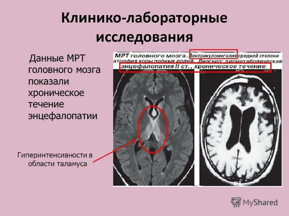 Резидуальные изменения головного. Дисциркуляторная энцефалопатия головного мозга на кт. Метаболическая энцефалопатия головного мозга мрт. Сосуды головного мозга мрт энцефалопатии. Посттравматическая энцефалопатия мрт.