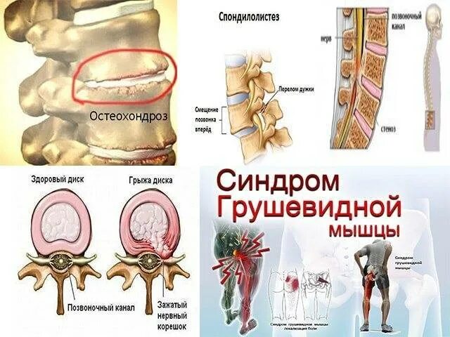 Защемление в поясничном отделе позвоночника