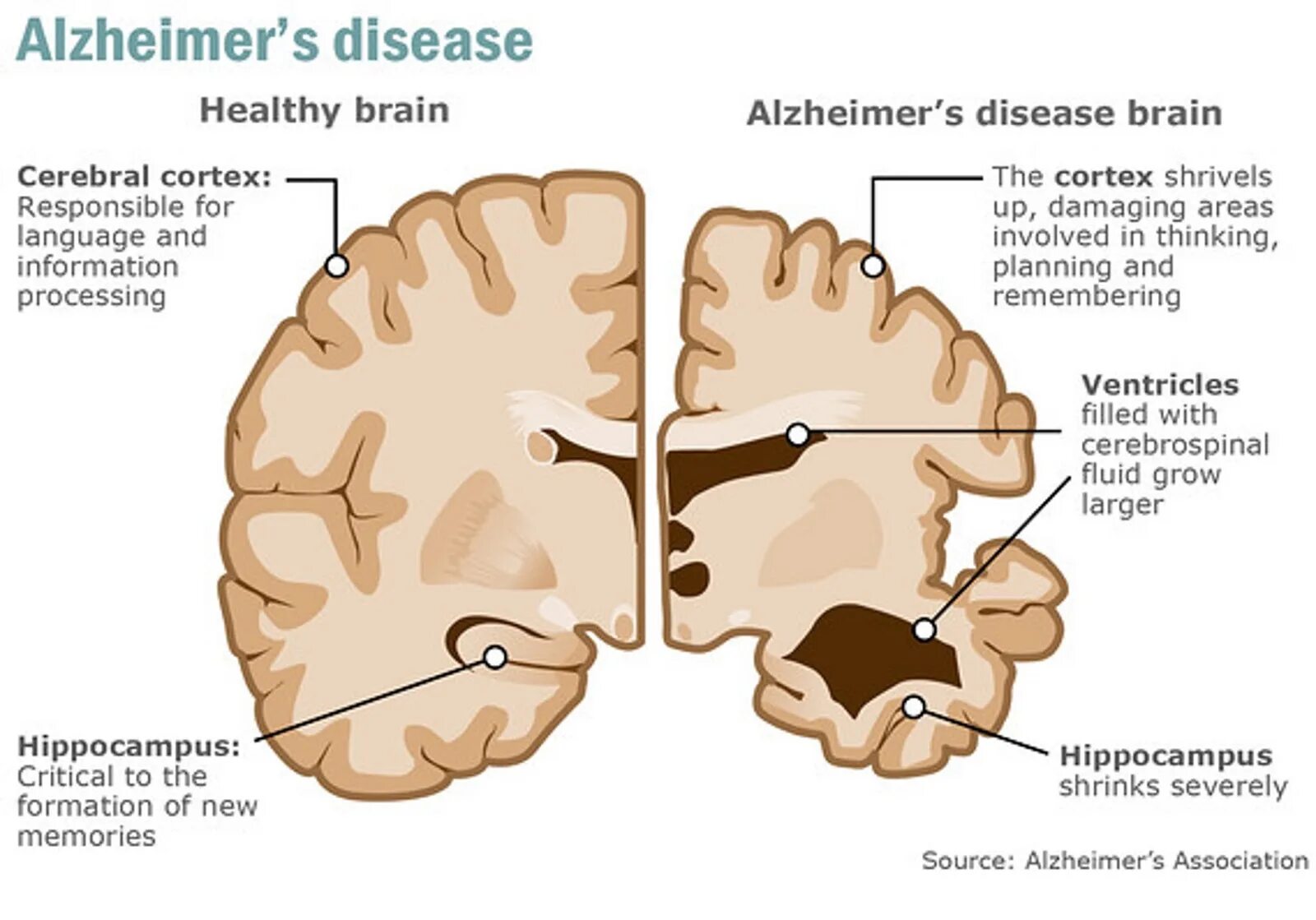 Болезнь заболевание мозга. Болезнь Альцгеймера локализация поражения. Болезнь Альцгеймера мозг. Головной мозг при болезни Альцгеймера. Мозг больного Альцгеймером.