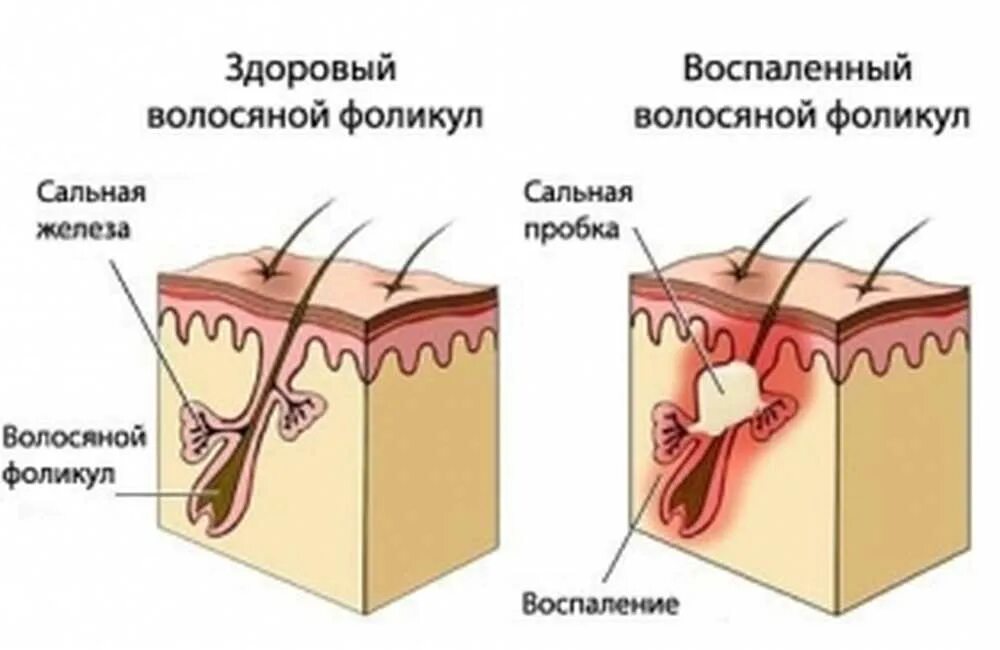 Что делает сальная железа. Закупоренная сальная железа на голове. воспаление волосяного фолликула. воспаление кожи головы. воспаленные сальные железы.