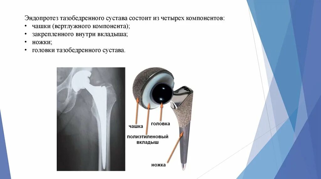 Вертлужный компонент эндопротеза тазобедренного сустава. Вертлужного компонента эндопротеза тазобедренного сустава рентген. Чашка эндопротеза тазобедренного сустава. Загородний эндопротезирование тазобедренного сустава. Эндопротезирование тазобедренного отзывы пациентов