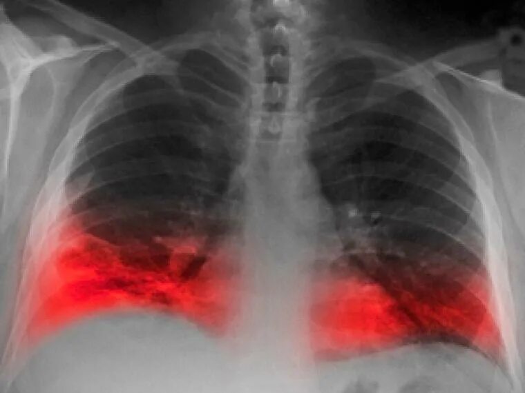 Подозрения на бронхит. Острый бронхит снимок рентген. Рентген легочное кровотечение туберкулез. Атипичная пневмония рентген.