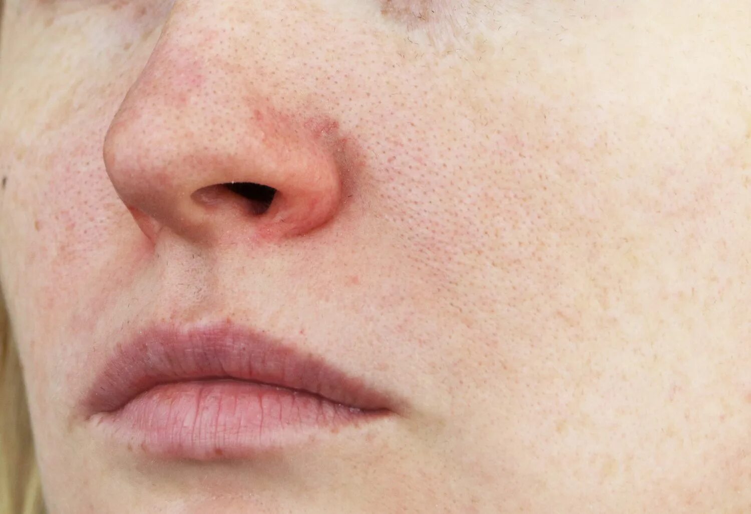 Rosacea: What It Looks Like, Causes, and Treatment