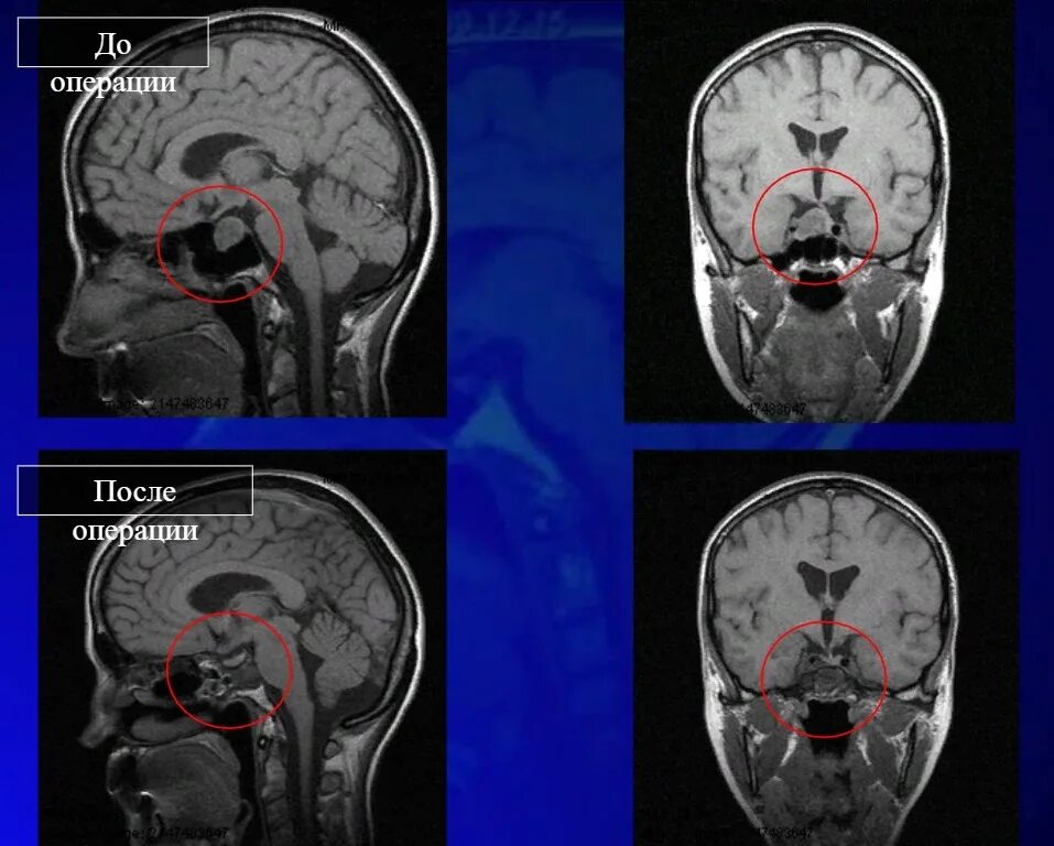 Аденома гипофиз мозга что это такое. Микроаденома мрт. Мрт головного мозга аденома гипофиза. Микроаденома гипофиза кт. Микроаденома головного мозга гипофиза микроаденома.