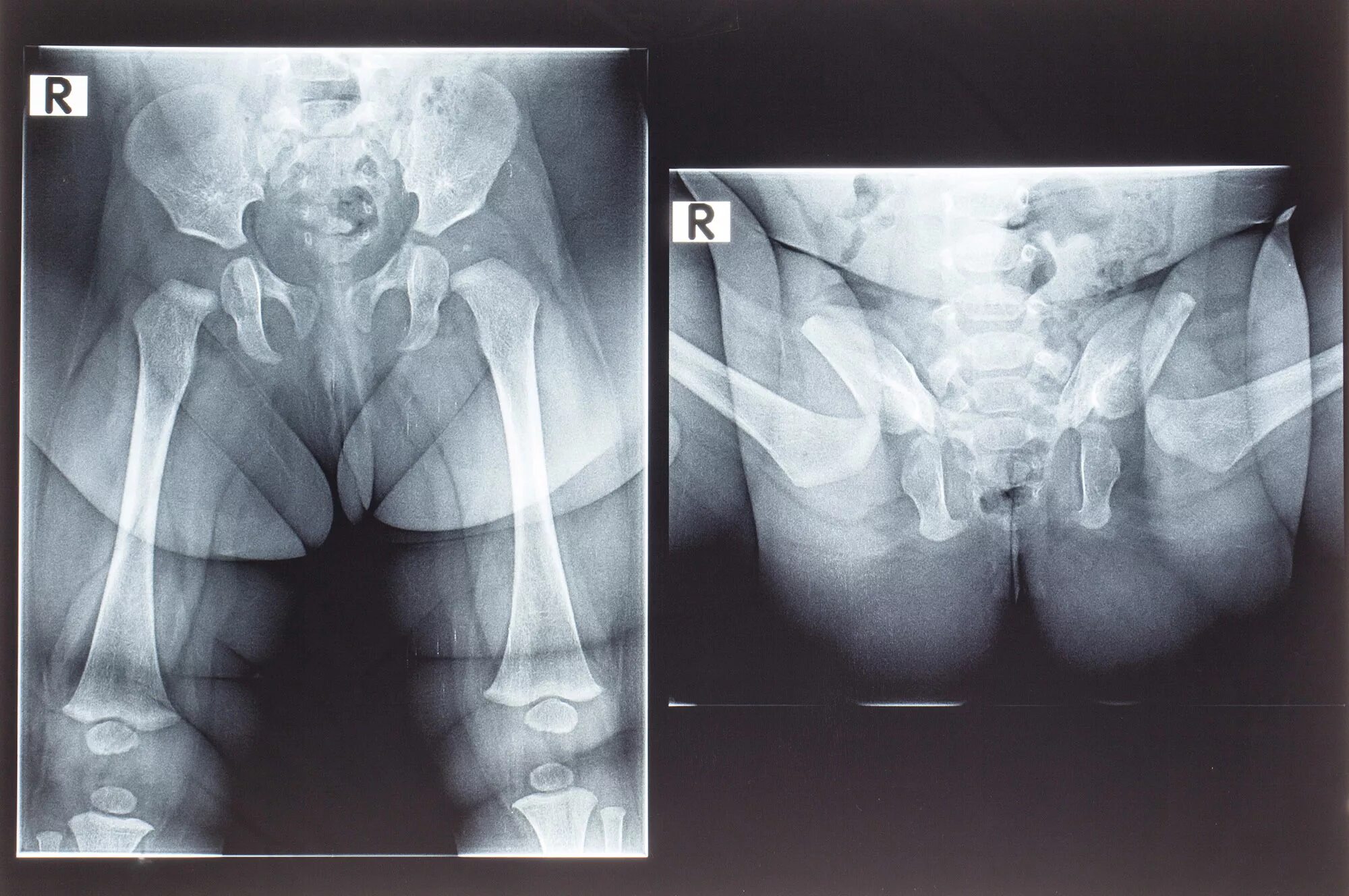Дисплазия сустава у новорожденного лечение. Дисплазия тазобедренных суставов у детей рентген. Дисплазия тазобедренных суставов Рент. Рентген тазобедренных суставов у детей норма. Дисплазия тазобедренных суставов рентген 5 лет.