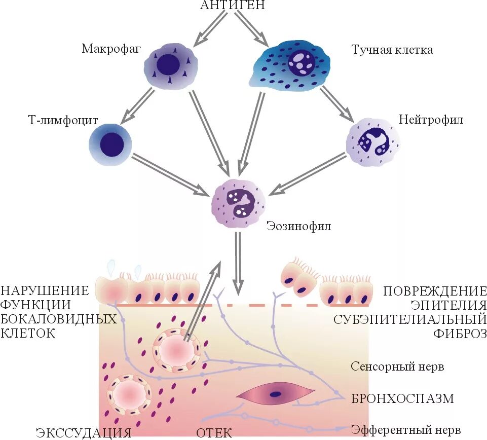 Механизм бронхиальной астмы схема. Механизм развития бронхиальной астмы схема. Клетки участвующие в воспалении при бронхиальной астме. Фазы патогенеза бронхиальной астмы. Эозинофилы при астме