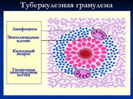 Клетки туберкулезного бугорка