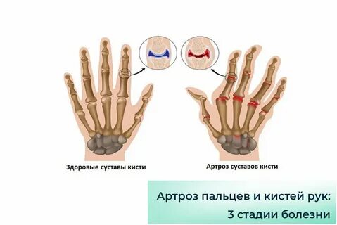 Скованность суставов пальцев рук причина