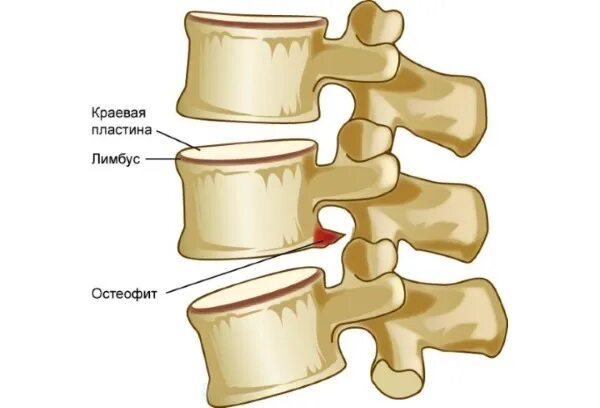 Краевые остеофиты тел позвонков поясничного отдела. Краевые остеофиты тел позвонков что это такое. Костные остеофиты l2-s1. Спондилёз грудного отдела позвоночника th7.