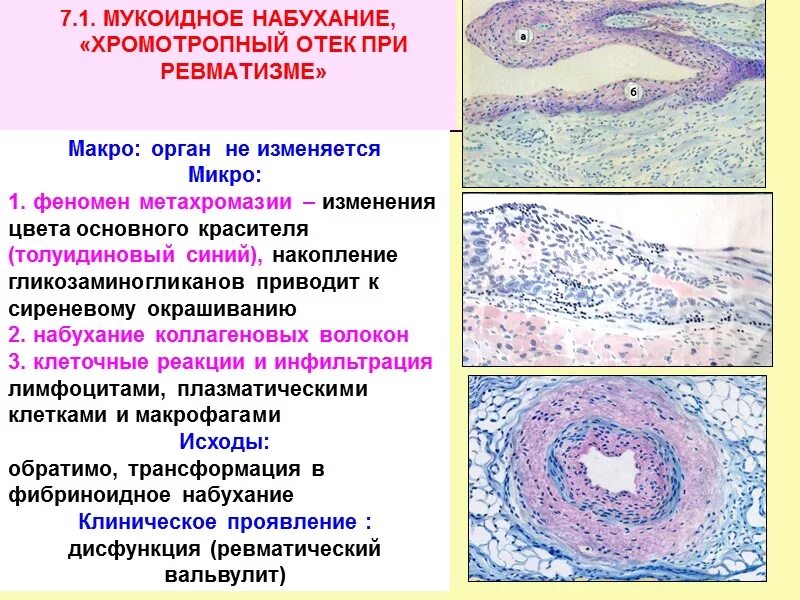 Белковые мезенхимальные дистрофии. Мезенхимальные дистрофии таблица мукоидное набухание. Мукоидное набухание это дистрофия. Белковые мезенхимальные дистрофии мукоидное набухание. Ревматоидный артрит микропрепарат описание.