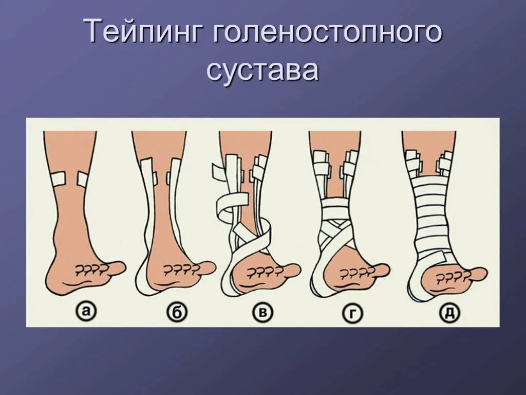Как тейпировать голеностоп при растяжении. Тейп на голеностопный сустав при растяжении. тейп голеностоп растяжение. тейпирование голеностопа при разрыве связок. тейпирование голеностопа при растяжении.