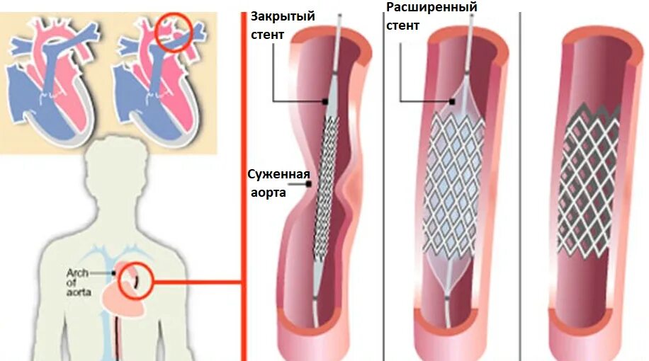 Как ставят стент